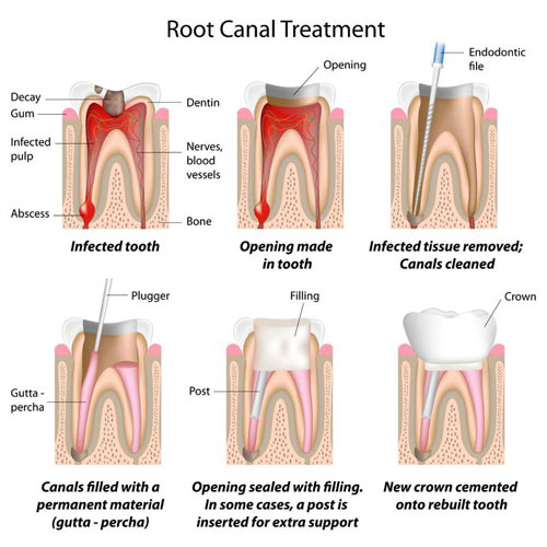 ballarat root canal treatment