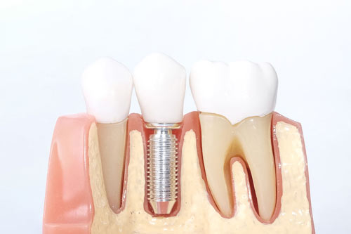 dental implants ballarat