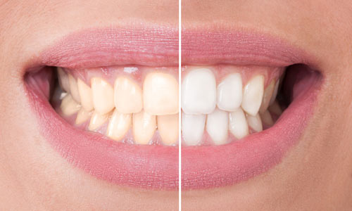 teeth whitening ballarat