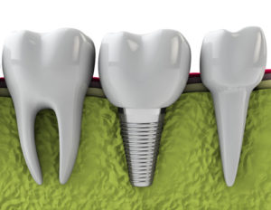 dental implants