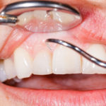 risk for periodontal disease