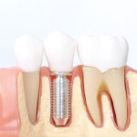 can dental implants help