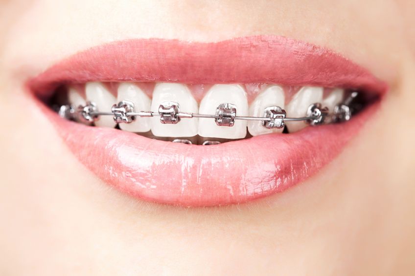 What Support Does Orthodontic Treatment Provide? Ballarat Dentist