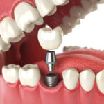 dental implants procedure recovery