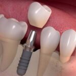 dental implants