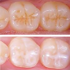 fissure sealants